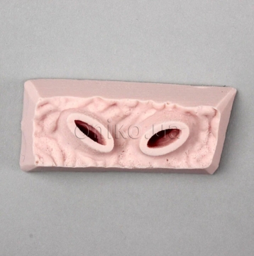 EMS язва желудка superior