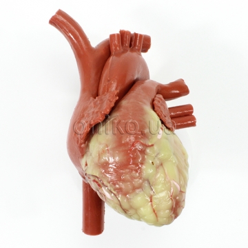 Серце для CABG (коронарного шунтування)