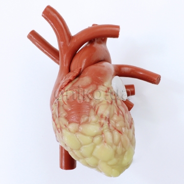 Серце зі змінним вушком лівого передсердя