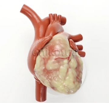 Серце без прохідних судин