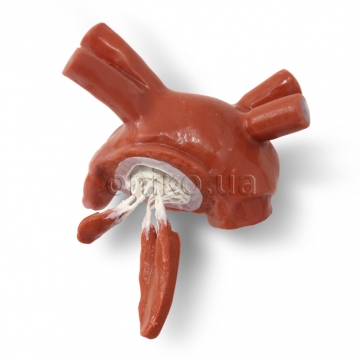 Пролабований мітральний клапан з хордами та папілярними м’язами