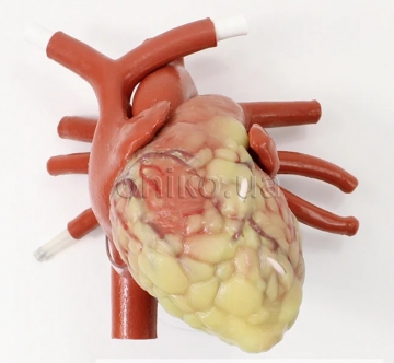 Збільшене серце дорослого пацієнта для малоінвазивної кардіохірургії мітрального клапана та аортокоронарного шунтування