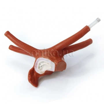 Збільшене ліве передсердя дорослого пацієнта з пролабованим мітральним клапаном для малоінвазивної кардіохірургії