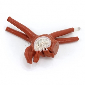 Збільшене ліве передсердя дорослого пацієнта з пролабованим мітральним клапаном, хордами та папілярними м’язами для малоінвазивної кардіохірургії