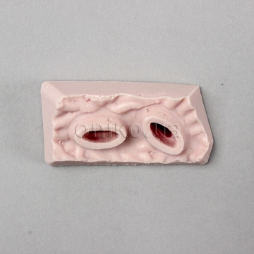 Тканина з нижньою виразкою шлунка