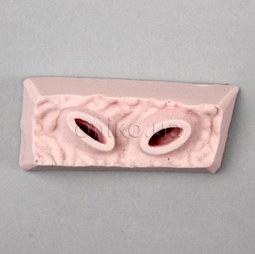 Тканина з верхньою виразкою шлунка