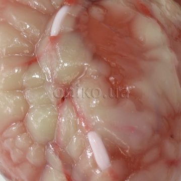 Ділянки для аортокоронарного шунтування