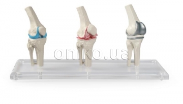 Модель колінного імплантату