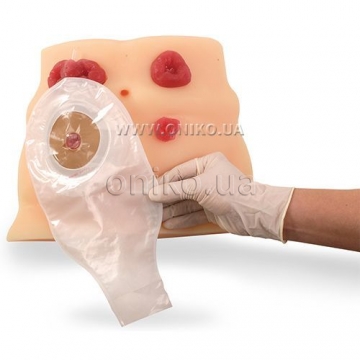 Ostomy Care Model