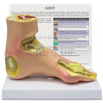 Gout