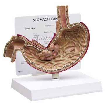 Stomach Cancer