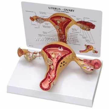 Uterus-Ovary