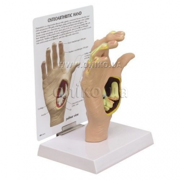 RUCE, OSTEOARTRÓZA