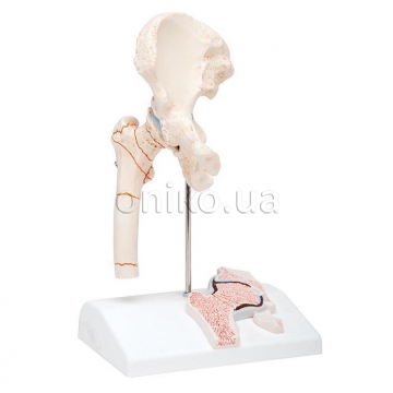 Model zlomeniny stehenní kosti a osteoartrózy kyčelního kloubu