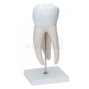 Верхній кутній зуб з карієсом