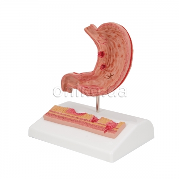 Human Stomach Section Model with Ulcers