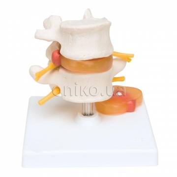 Human Lumbar Spinal Column Model with Dorso-Lateral Prolapsed Intervertebral Disc