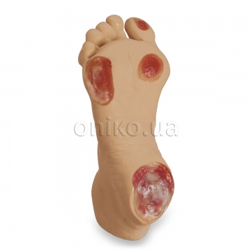 Elderly Pressure Ulcer Foot