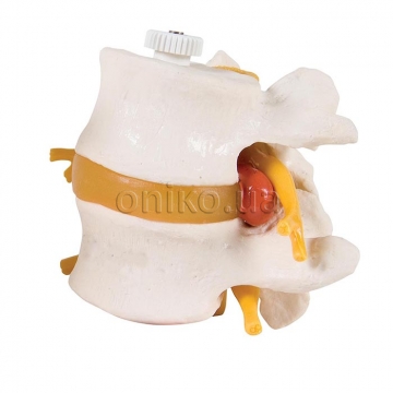 2 Human Lumbar Vertebrae with Prolapsed Disc, Flexibly Mounted