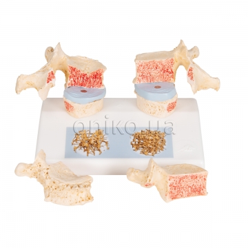 Osteoporosis Didactic Model