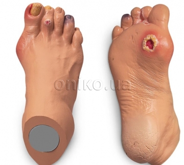Advanced Foot Problems