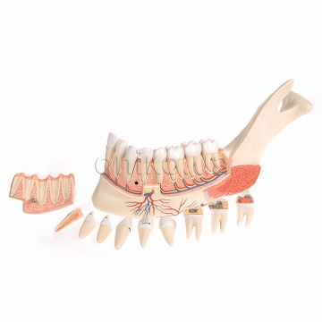 Comprehensive Lower Jaw Model (Left Half) with Diseased Teeth, Nerves, Vessels & Glands, 19 part